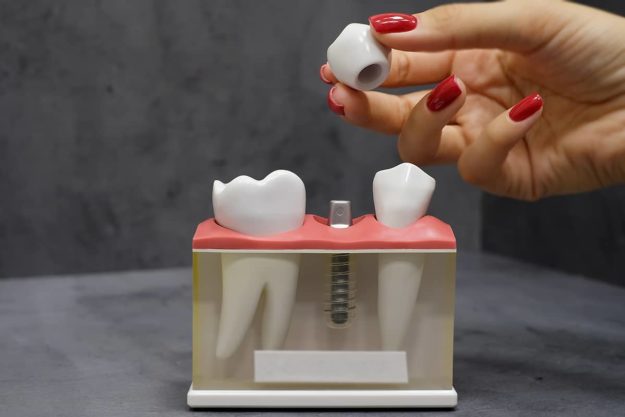 dental implants-2 model of dental implants