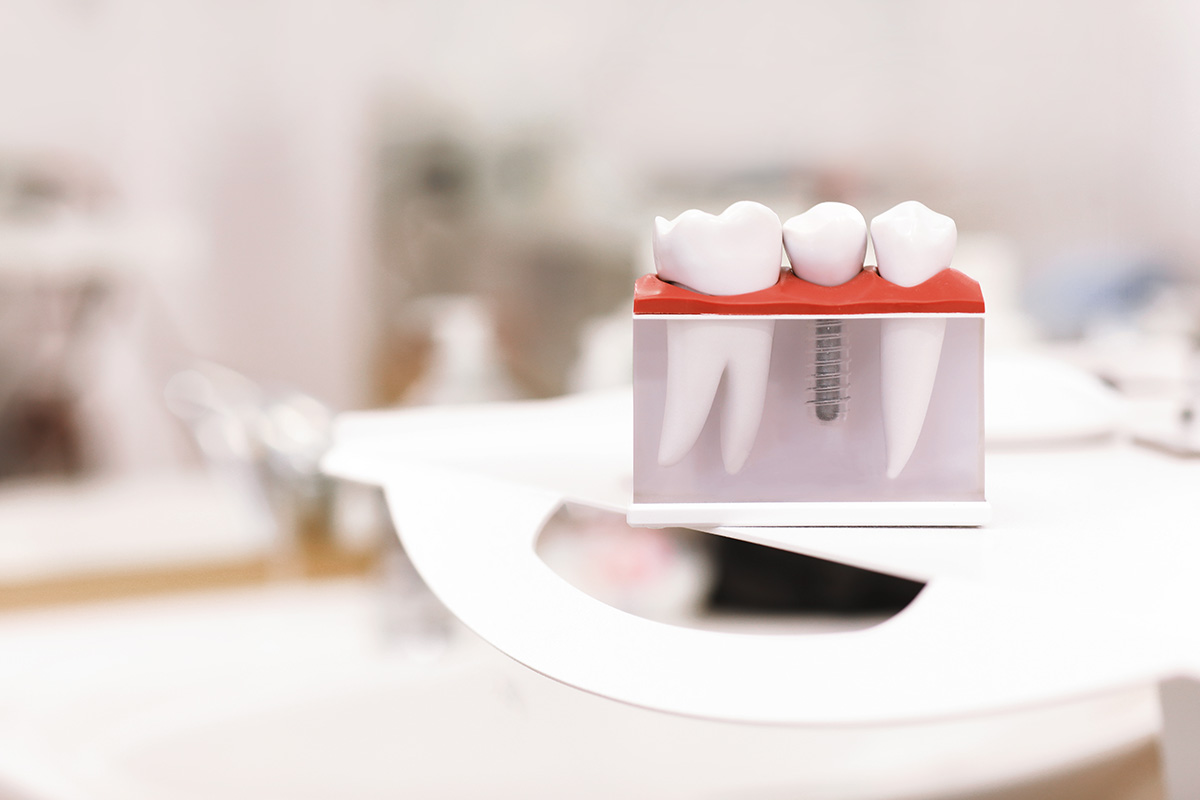 What is a Single Tooth Implant_ (1) model of a single tooth implant