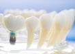 model of a dental implant