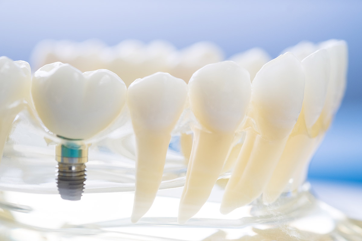 model of a dental implant