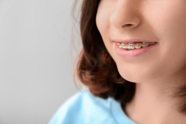 girl getting braces for kids
